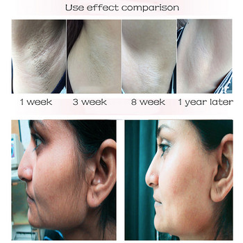 Μηχάνημα αποτρίχωσης FIEEZOE IPL Laser 999999 Flash Epilator For Women Permanent Photoepilator Painless Depiladora Facial