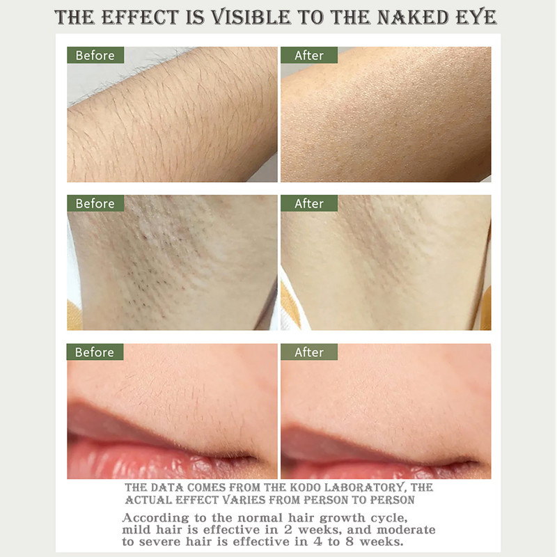 990 000 blyksnių 2022 m. Naujas Lazerinis Parduodu Lazerinis Epiliatorius Nuolatinis IPL Fotoepiliatorius Plaukų šalinimas Neskausmingas elektrinis epiliatorius