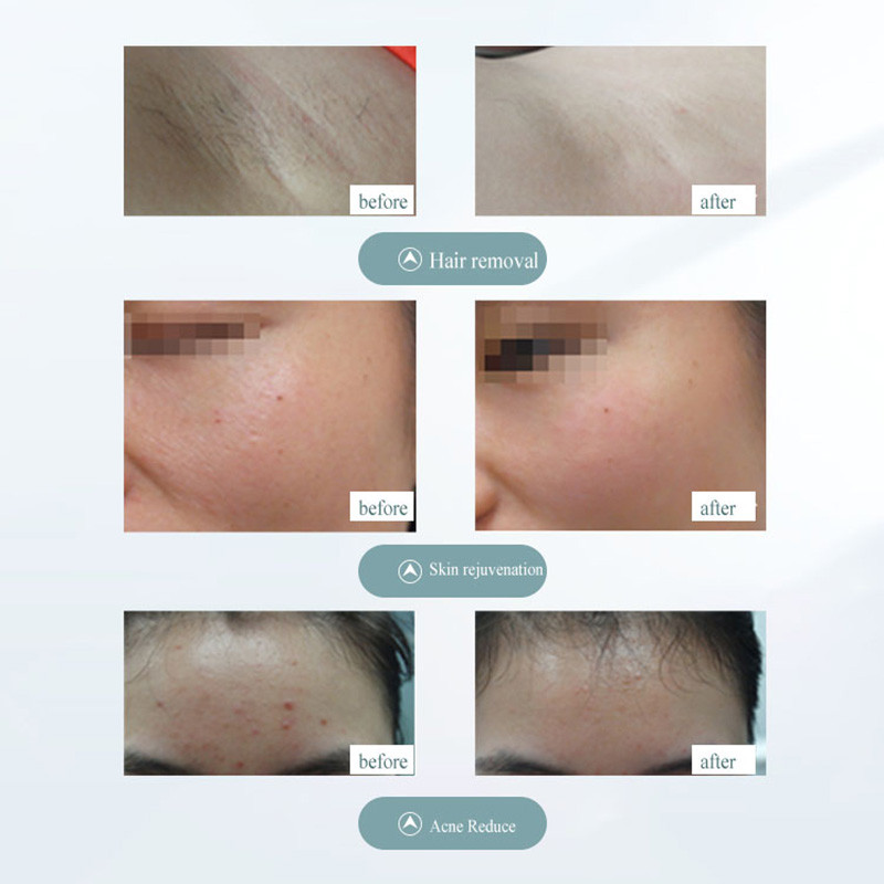 Electric 999999 Flashes IPL Laser Epilator Photon Hair Removal Photoepilator LED Home Depiladora Ξυριστική μηχανή μπικίνι μασχάλης ανώδυνη