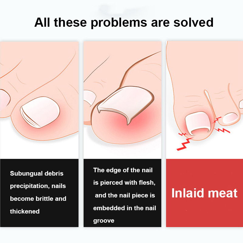 Körömvágók Benőtt köröm Eszközök Pedikűr Manikűr Olecran Professzionális vastag Paronychia korrekciós eszköz Dropshipping
