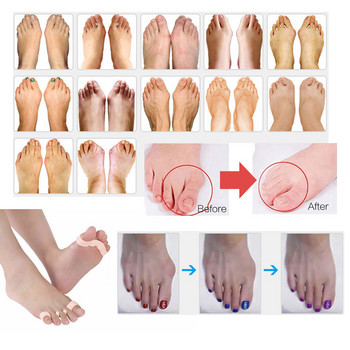 1 Pairs Orthotic Gel Separators Toe Separers Spacer Straightener Bunion Foot for Overlading Toe Pain Bunion