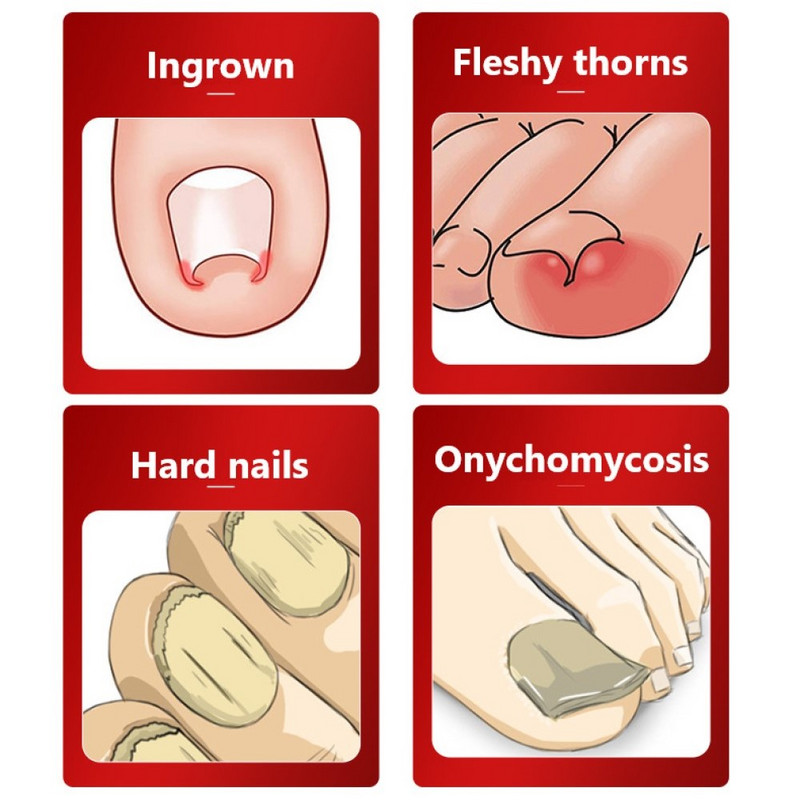 1 τεμ. από ανοξείδωτο ατσάλι Ingrown Nail Art Nipper Scissors Paronychia Dead Skin Remover Trimming Nail Clipper Εργαλεία πεντικιούρ