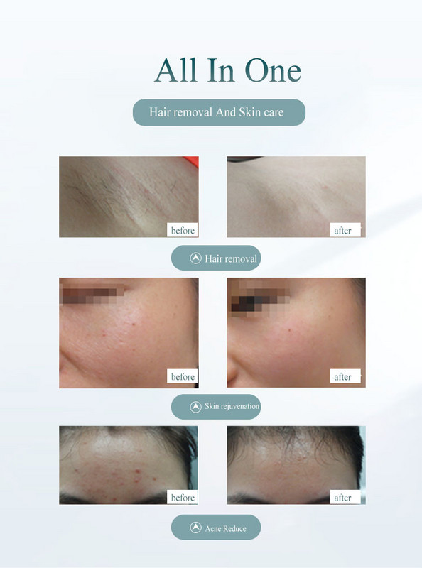 2022New 900000Flashes Laser Epilator Laser Hot Sell Permanent IPL Photoepilator Αποτρίχωση Ανώδυνη ηλεκτρική μηχανή αποτρίχωσης