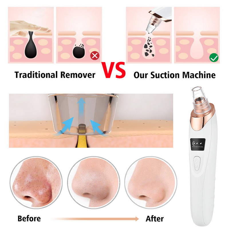 Îndepărtând punctele negre Aspirator pentru curățarea porilor Curățarea feței Puncte negre Aspirație Exfoliant Frumusețe Acnee Instrument de îndepărtare a cosurilor Îngrijirea pielii