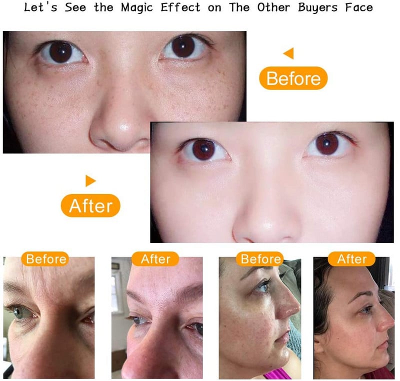 Mașină facială cu electrozi de înaltă frecvență 7 în 1 Tub de sticlă Baghetă pentru acnee Dispozitiv de îndepărtare a petelor de acnee Mașină de înfrumusețare spa facială de înaltă frecvență