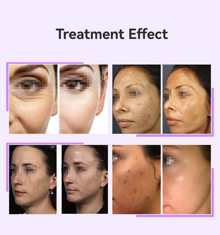 Štapić za elektroterapiju Zamjena staklene cijevi Visokofrekventni aparat za lice Zatezanje kože protiv akni Visokofrekventni aparat za njegu kože lica