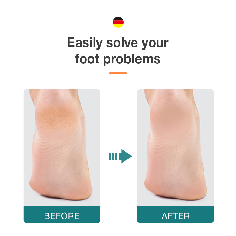 MR.GREEN lábreszelő kétoldalas bőrkeményedés eltávolító elhalt bőrre Professzionális pedikűr eszközök Callous Scraper Foot Sander sarokszűrő