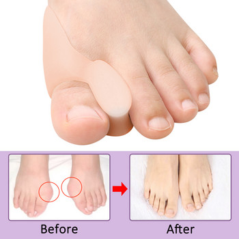 Pexmen 2/4Pcs Gel Big Toe Bunion Pads Προστατευτικά διαχωριστικά δακτύλων για στραβά επικαλυπτόμενα δάχτυλα Διορθωτική ασπίδα διαχωρισμού