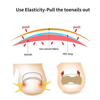 Αυτοκόλλητο Ingrown Nail Corrector Strap Anti-roll Nail Free Glue Toe Inlay Nail Corrector Patch Διόρθωση Αυτοκόλλητα Νύχι