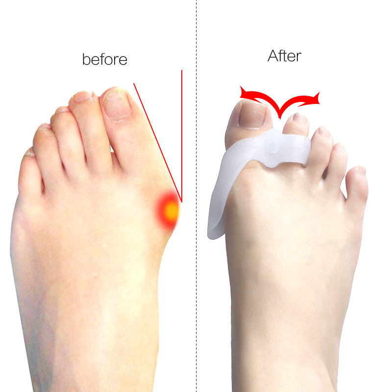 Corector al degetului osos Instrumente de îngrijire a picioarelor Corector de bunion Separatoare de degete Hallux Valgus Stretcher Corectarea degetului mare