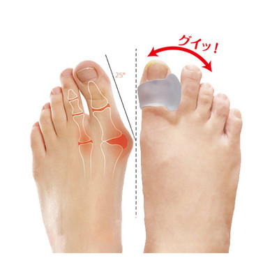 2db=1pár szilikon gél nagylábujj elválasztó bunion állító lábujjak protektor Csont Hallux Valgus Corrector lábápoló pedikűr