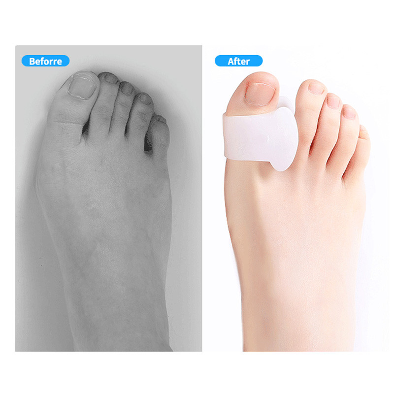 2db=1pár szilikon gél nagylábujj elválasztó bunion állító lábujjak protektor Csont Hallux Valgus Corrector lábápoló pedikűr