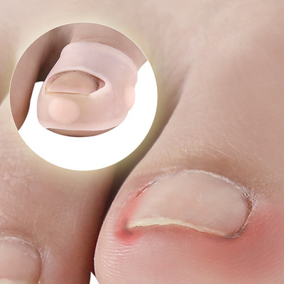 1 pereche de instrumente de corectare a unghiilor încarnate din silicon de la picior pentru tratamentul unghiilor de la picioare invizibile, cu clemă de îndreptare elastică