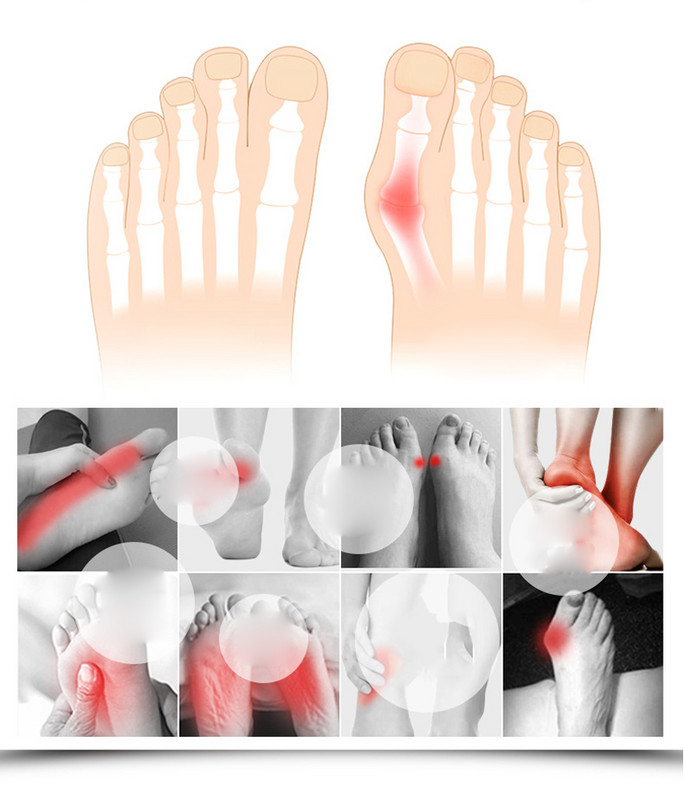 2vnt Bunion Corrector Hallux Valgus Corrector pirštų atskyrikliai pedikiūro įrankis Bone Nykštys Ortopedinės petnešos pėdos apsaugos įtvaras