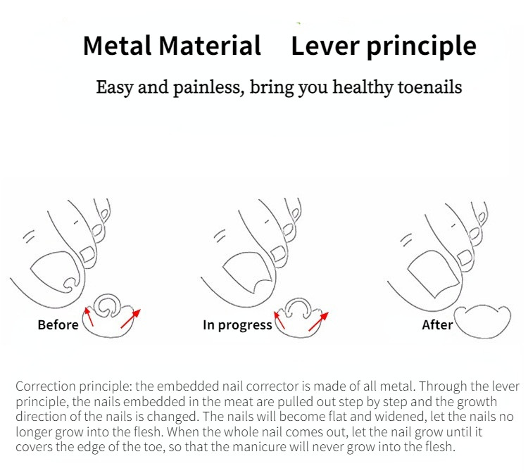 Novi alat za korekciju oporavka od uraslog nokta za pedikuru Sredstvo za učvršćivanje noktiju na nogama Alat za njegu noktiju stopala Ortopedski korektor za nokte Alat za pedikuru