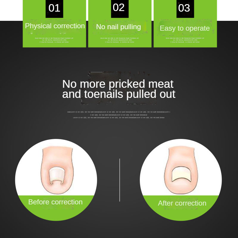 Novi alat za korekciju oporavka od uraslog nokta za pedikuru Sredstvo za učvršćivanje noktiju na nogama Alat za njegu noktiju stopala Ortopedski korektor za nokte Alat za pedikuru