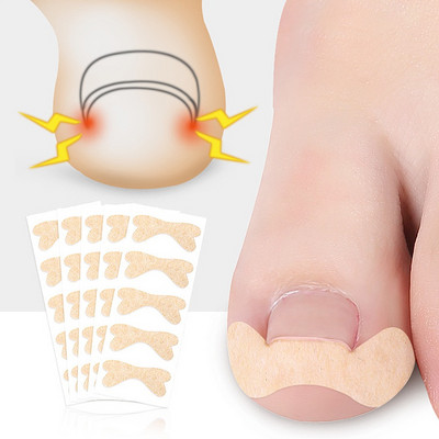 Corect pentru unghii încarnate Autocolant Fixator pentru tratament paronichie Recuperare bunion Pedichiură Instrument de îngrijire a unghiilor degetelor de la picioare