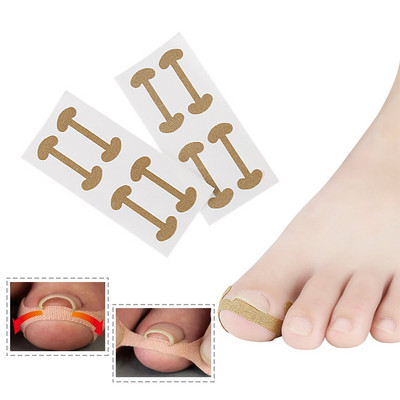 Bunion Corrector įaugusių kojų nagų korektorius Lipdukas paronichijos gydymui Fixer Recover bunion Pedikiūras Pėdų kojų pirštų nagų priežiūros priemonė