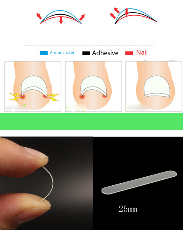Педикюр Инструмент за корекция на ноктите на пръстите на крака Лечение на ноктите Еластична лепенка Стикер Изправяща скоба Инструменти за грижа за краката