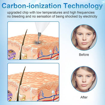 Надстройте писалката за премахване на бенки Преносима писалка за премахване на етикети от кожата с 9 нива на якост за лице, тяло, брадавици, лунички, невус, лечение на петна