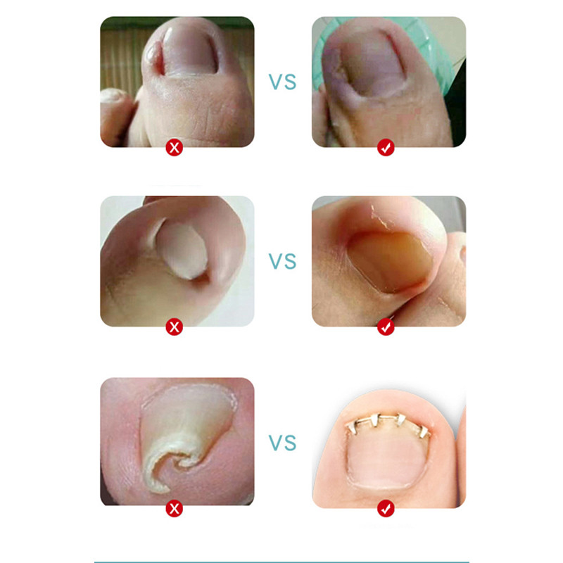 1 buc. Instrument profesional pentru corectarea unghiilor încarnate de la picioare, fixator de sârmă, instrument de tratament, pedichiură, paronichia, corector de unghii de la picioare, reutilizabil