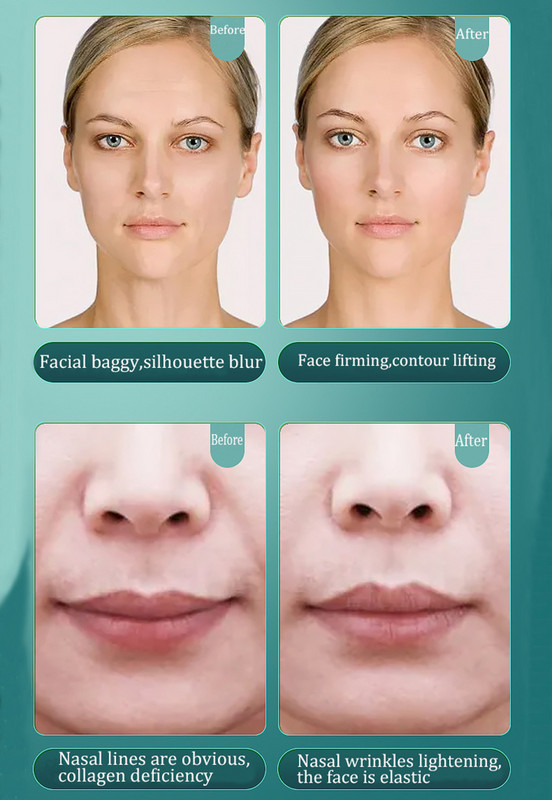 Najnoviji mini HIFU 3 3. generacije RF ultrazvučni EMS Pulse Rejuvenation Tighten Lifting Skin Care Originalni masažer za lice