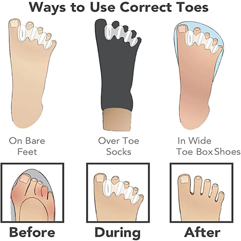 2 bucăți silicon trei găuri separator degete tratament ciocan degetele picior îndreptat Hallux Valgus corectare tampon de protecție instrument de îngrijire a picioarelor