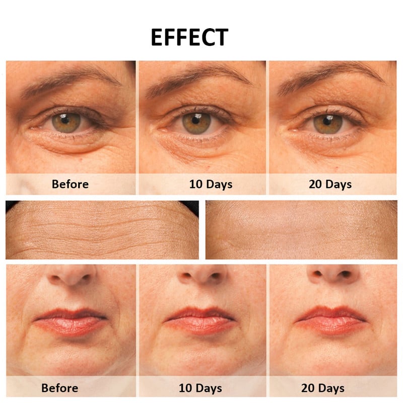 RF Face Lift eszközök elektromos bőrfiatalítás rádiófrekvenciás arcmasszírozó fényterápia öregedésgátló ráncok bőrfeszesítése