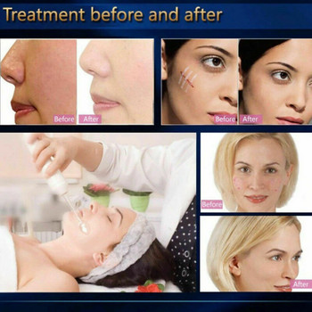 Υψηλής συχνότητας Beauty Skin Care Facial Spa Salon acne Καλλυντικό όργανο Μασάζ Χαλάρωση όζοντος ηλεκτροθεραπεία χτένα περιποίηση προσώπου