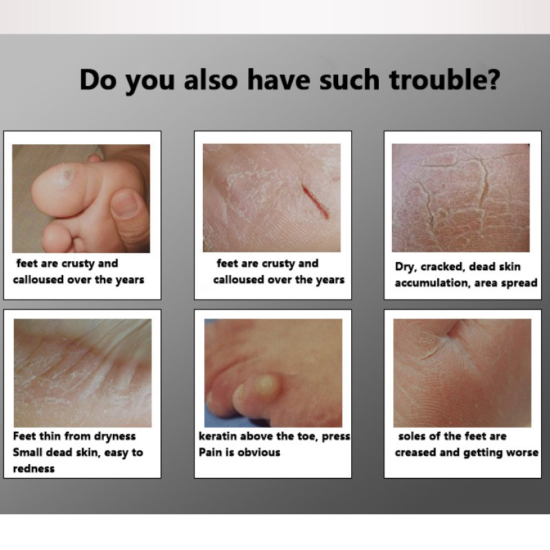 2022 Νέο επαναφορτιζόμενο ηλεκτρικό μηχάνημα αφαίρεσης τύλου Συσκευή πεντικιούρ Foot File Εργαλείο περιποίησης ποδιών για τακούνια Αφαίρεση νεκρού δέρματος Εργαλείο