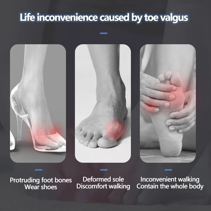 Pexmen 2vnt Tailor's Bunion Corrector Pad Bunionette tiesintuvas Pinky Toe Separator Protector Shield Skausmą malšinantis tarpiklis