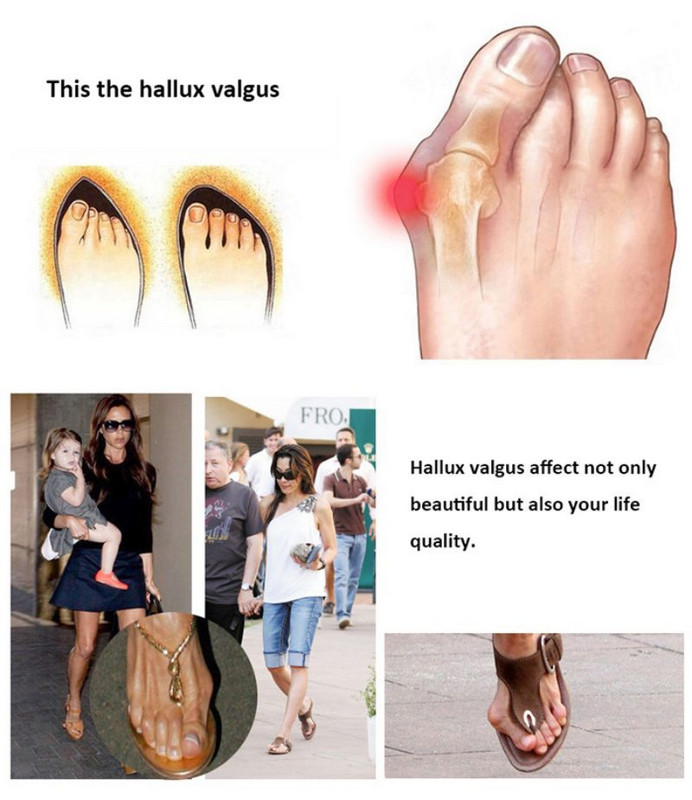 Soft Bunion Corrector Lábujjleválasztó Corrector Orvosi eszköz Lábujjkorrektor Hallux Valgus Lábápolás Pedikűr Ortotikus kezelés