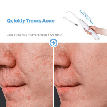 Преносима високочестотна пръчка за лице Грижа за косата Електрод Spot Acne Remover Грижа за кожата Лице Коса Спа Салон Устройство за красота