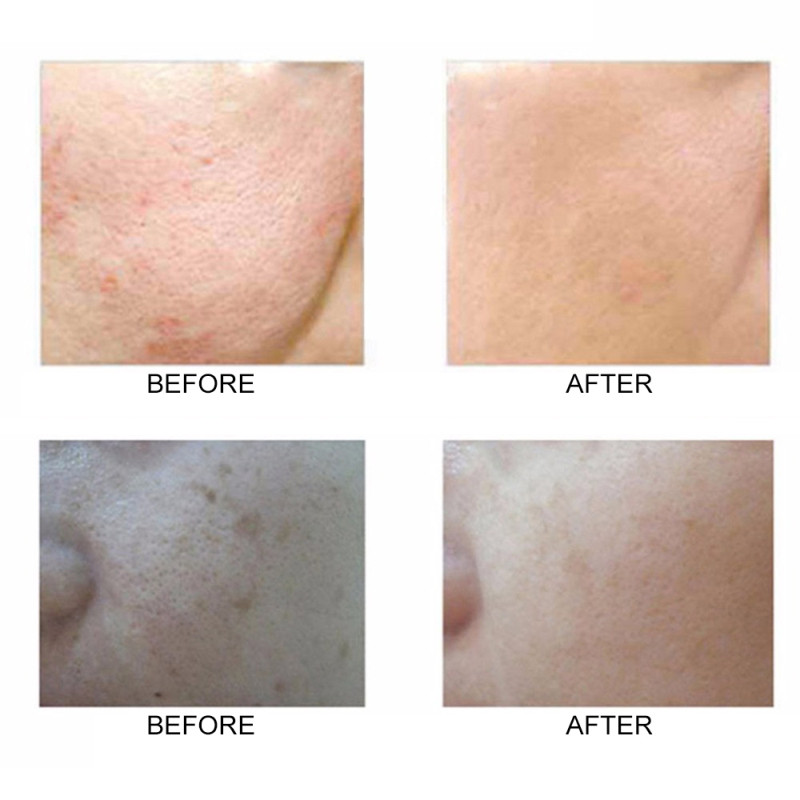 Dvostrano sredstvo za čišćenje lica Mekana četka Dubinsko čišćenje Uklanjanje mitesera Čišćenje lica Masaža Proizvod za pranje lica