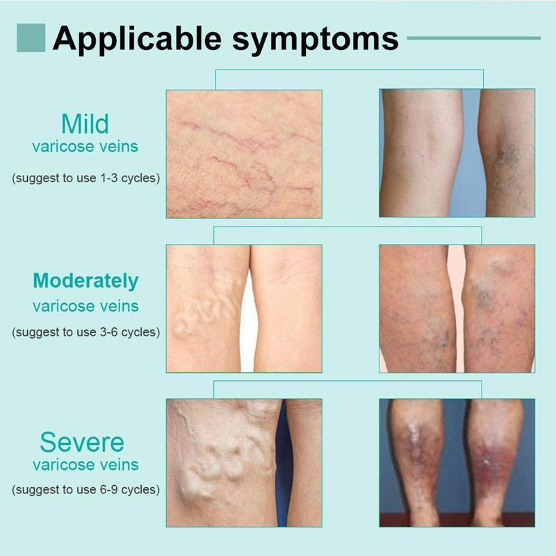 Nešiojamas terapinis rašiklis, skirtas raukšlėms pašalinti spuogus, galingas mėlynos šviesos spuogų rašiklis Akių odos priežiūros priemonė
