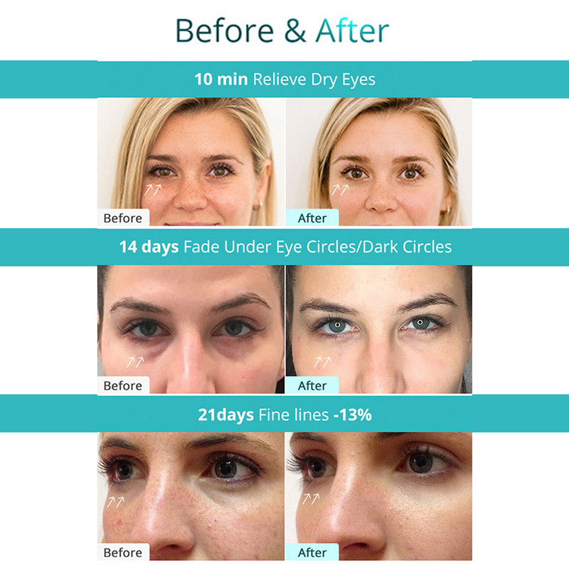 Mikrostrujna RF masažna maska za oči Električni flaster za oči Masažer Mini hidrogel vrući Smanjuje bore Natečenost Podočnjaci Vrećice