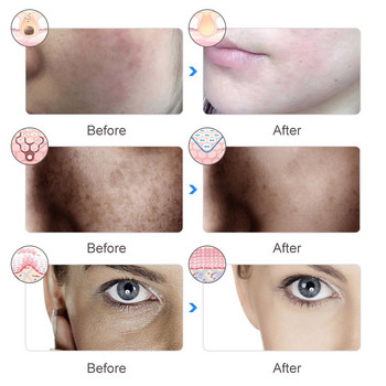 7 Χρώμα LED Μάσκα προσώπου Photon Therapy Anti Acne Wrinkle Facial Whiten Skin Rejuvenation Skin Care Beauty Mask Machine Recharging