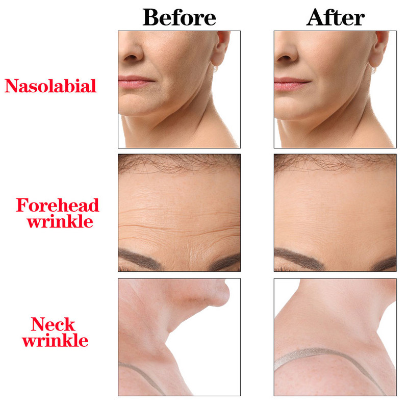 Autocolante cu gel siliconic antirid Întinerirea pielii Față Ochi Ochi Benzi pentru bărbie Plasture pentru lifting facial Anti-îmbătrânire