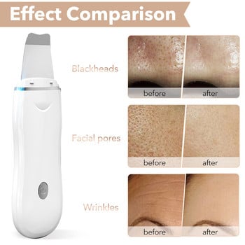 Σετ υπερήχων Skin Scrubber Vibration Spatula Face Remover Blackhead EMS LED Facial Massager Cavitation Peeling Facial Lifting