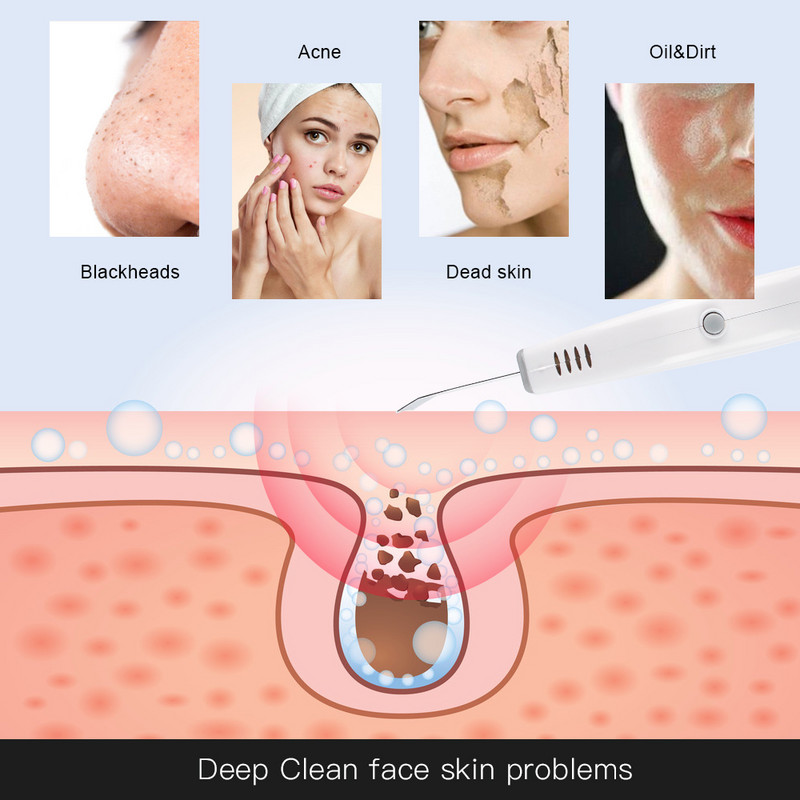 Erőteljes ultrahangos arcbőrradír Mélytisztító mitesszer pattanásos foltok eltávolító Peeling Beauty Bőrápoló lifting Massagr