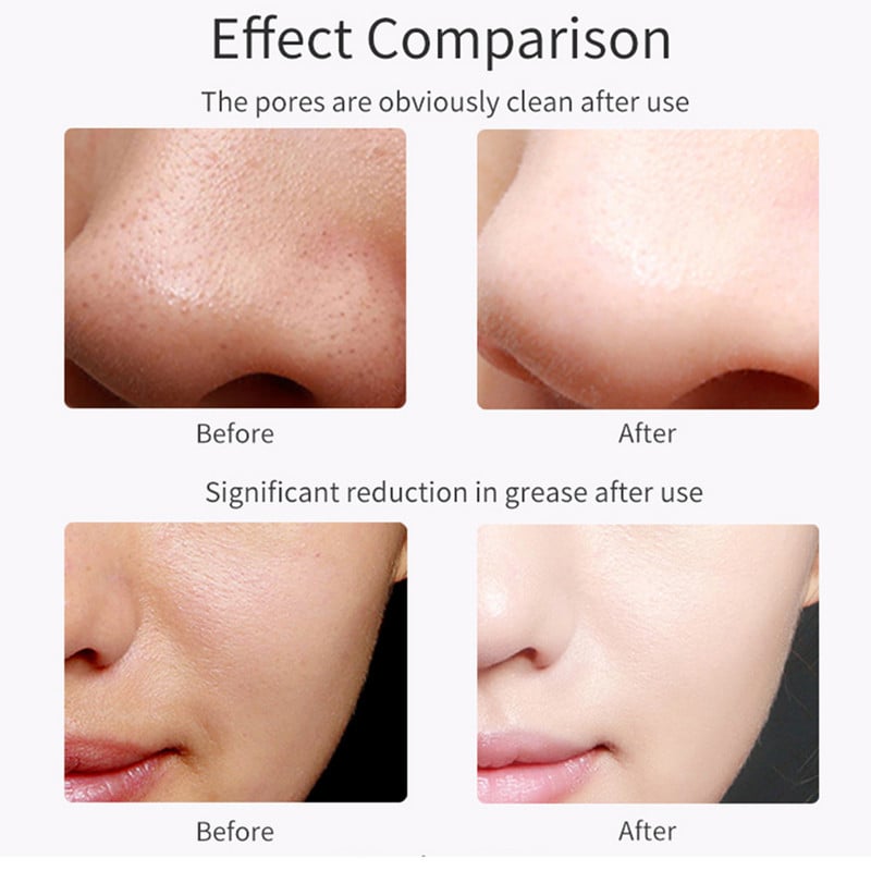 Beauty Face Cleaner Ultrahangos bőrradír USB csatlakozó Mitesszer eltávolító Arcmasszírozó Akne Bőrápoló Peeling Arc Kavitáció