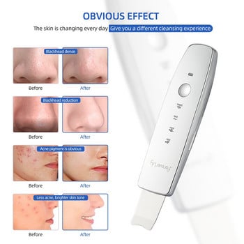 Ultrasonic Face Scrubber Beauty Red&Blue Light LED Photon Therapy EMS Peeling Προσώπου Ion Pore Clean Remove Blackhead Exfoliation