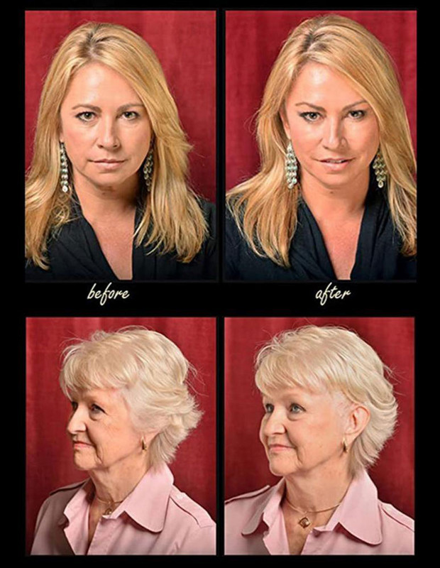 Alat protiv starenja Podizanje lica i vrata Instant traka za podizanje lica Trake za podizanje lica s kopčama