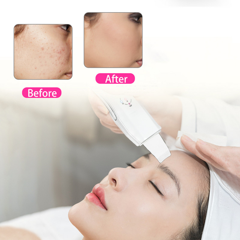 Beauty Star ultrahangos bőrradír masszírozógép arcbőrtisztító anionos arcbőrápoló ultrahangos peeling bőrradír