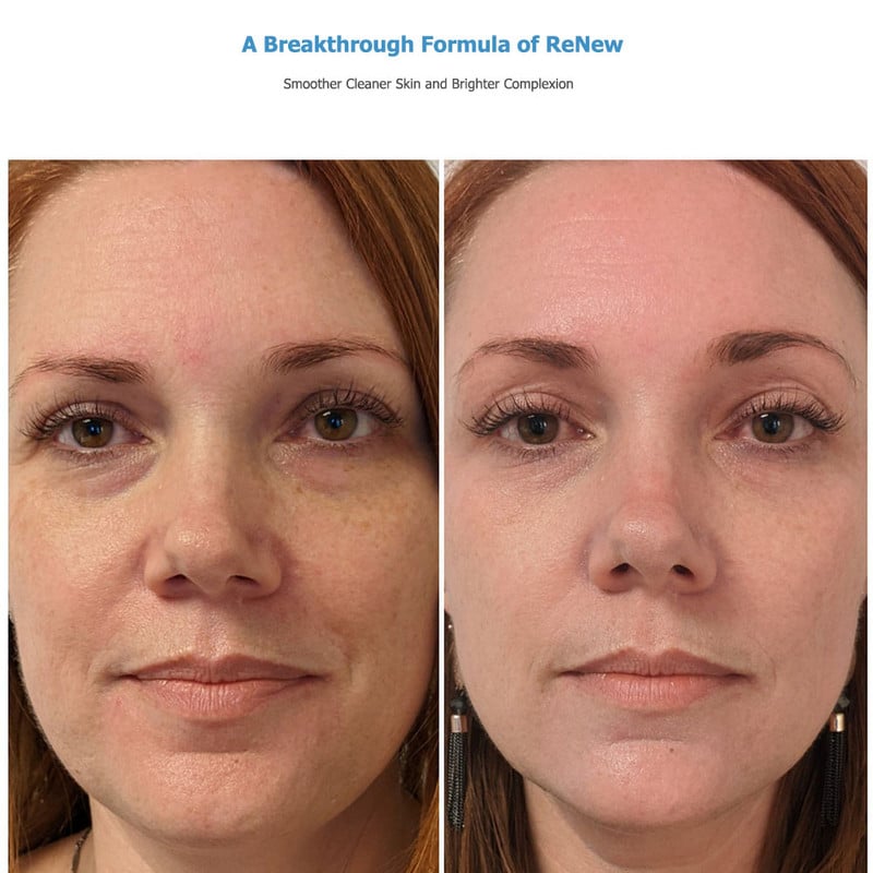 Beauty Star ultrahangos bőrradír tisztító arctisztító akne eltávolítás galvanikus arcfürdő ultrahangos peeling Clean Tone lifting