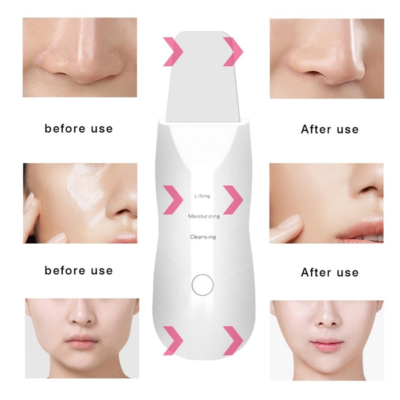 Ultrahangos bőrradír peeling mitesszer eltávolító mély arctisztító ultrahangos ionos ance pórustisztító arclapátos arctisztító