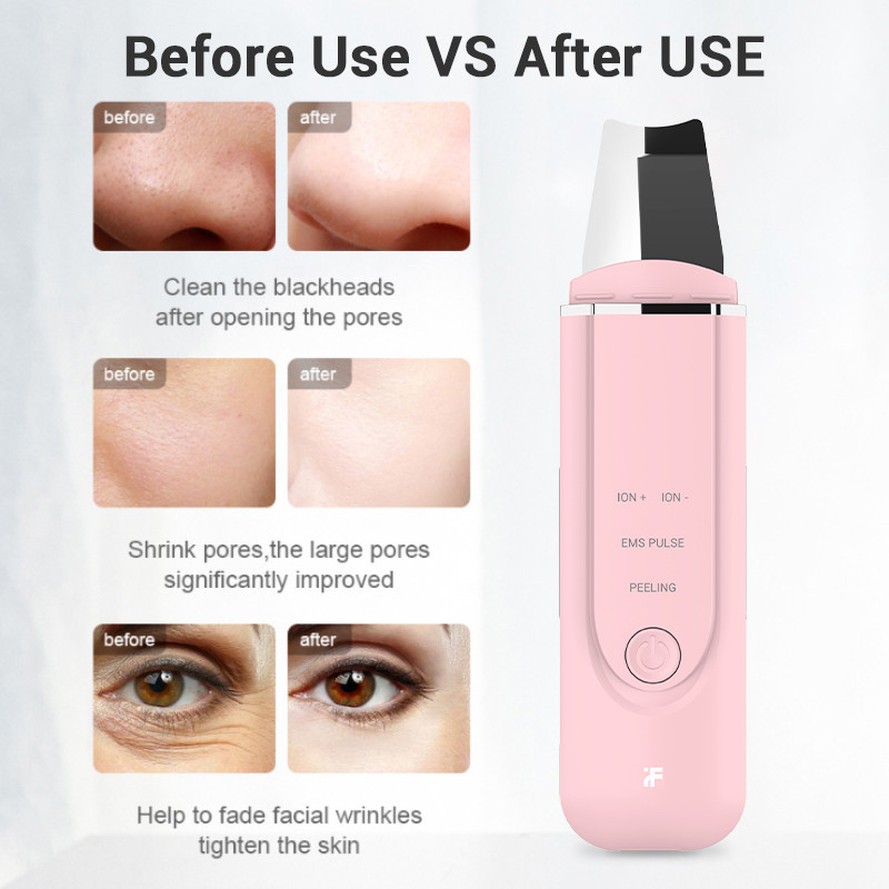InFace ultrahangos bőrradír tisztító mitesszer kavitációs peeling arcmasszírozó Beauty bőrápoló műszer