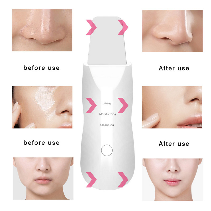 Ultrahangos arcbőrradír Professzionális mélytisztító peeling újratölthető bőrápoló készülék Beauty lifting gép