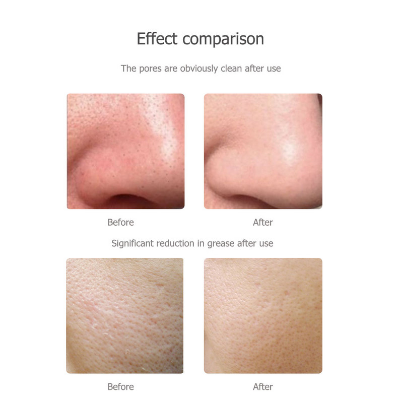 Ultragarsinis odos šveitiklis Beauty Face Shovel Porų valiklis Inkštirų valiklis Veido Masažuotojas Spuogų Odos Priežiūra Pilingas Lift Machine