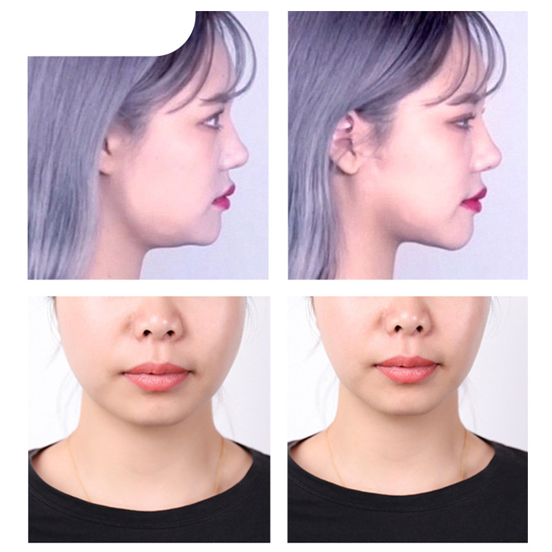 Yoxier 40 tk näo tõstmise kleebised nähtamatu veekindel joon kortsude õhuke näo näojoon V-kujuline nägu tõstev teip Scotch näole